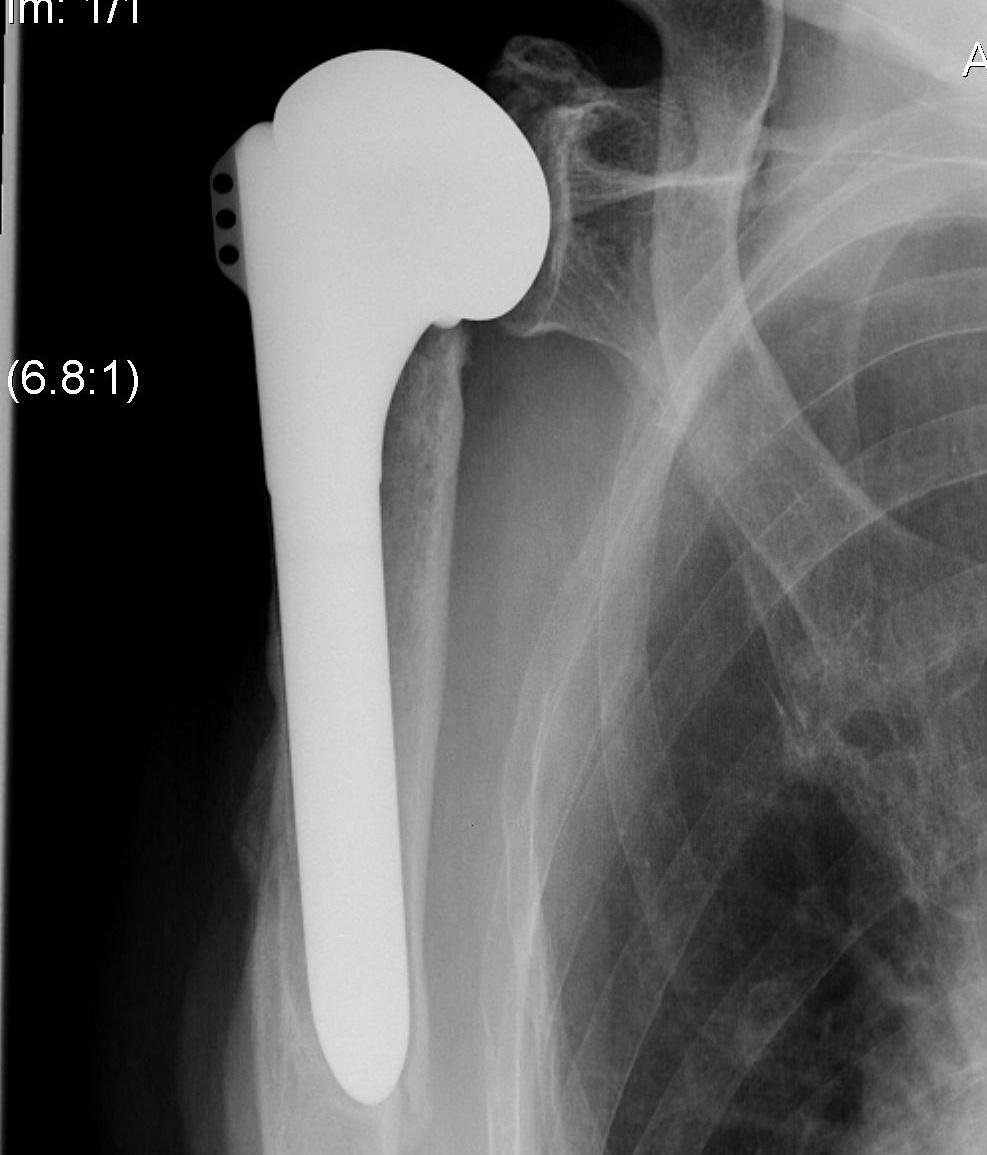 TSR Humeral Fracture 